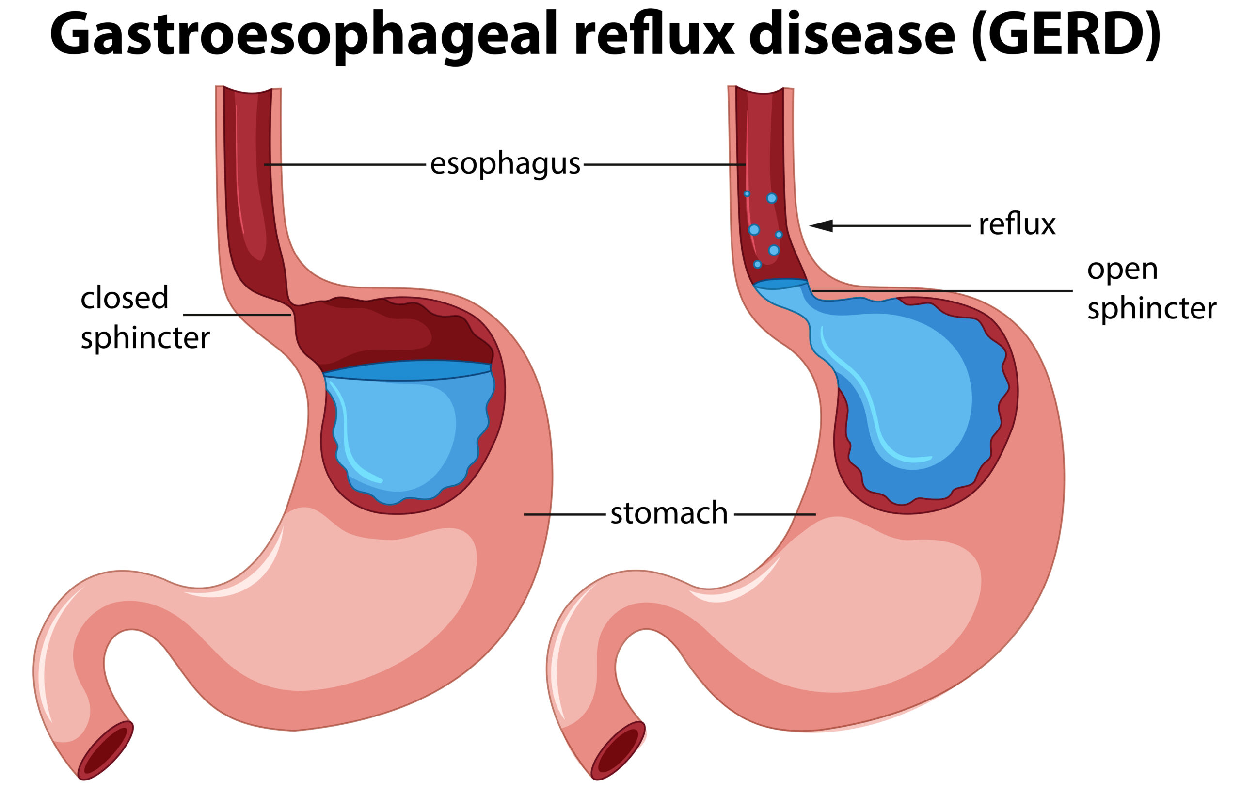 How can I manage symptoms of GERD (gastroesophageal reflux disease)?